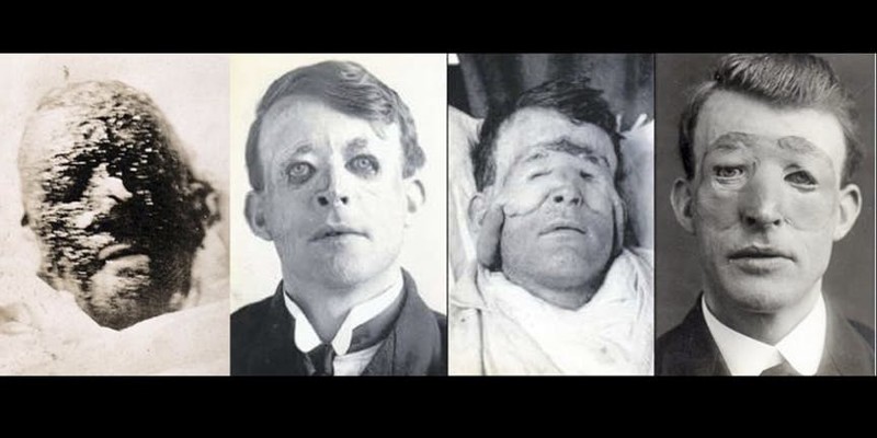 Рождение пластической хирургии интересно, история, первая мировая война, факты