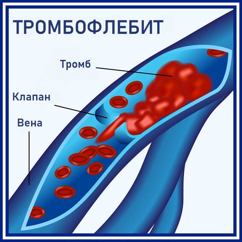 настойка из цветков конского каштана