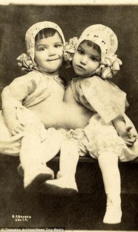 Гваделупа и Джозефина Инохоса были известны как Кубинские близняшки. Фотография сделана в 1914 году: «шоу уродов» в цирке процветали и в XX веке деформация, люди