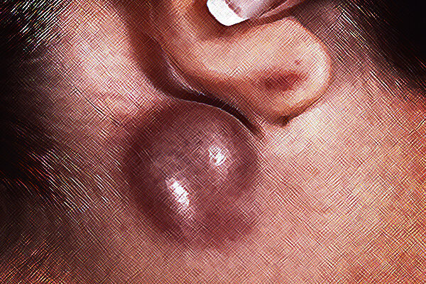 Увеличился лимфоузел. Когда нужно бить тревогу?