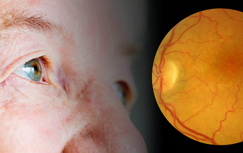 Дегенеративные изменения глаз - заболевания, которые сопровождаются нарушением обменных процессов в глазном яблоке, нарушением питания и восстановления тканей глаза.