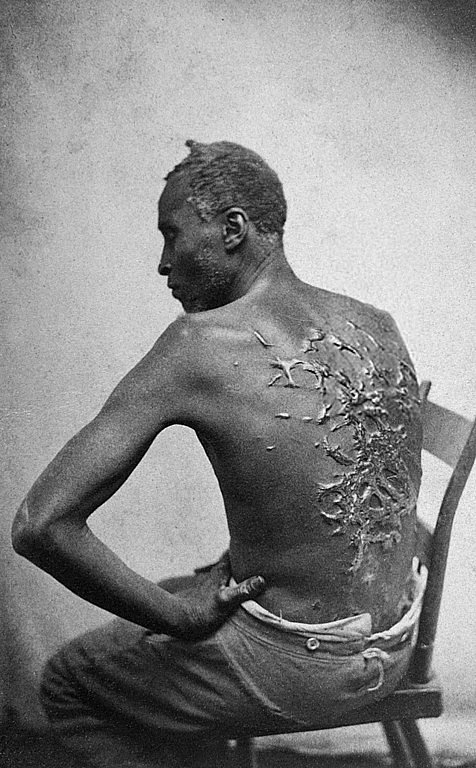 Известная фотография беглого раба Гордона — участника Гражданской войны в США — со следами от плети на спине. Фото сделано в 1863 году