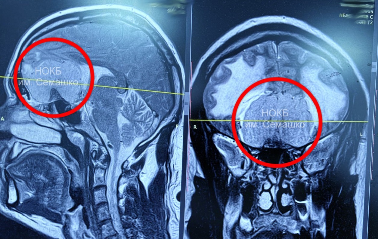 Пациента с гигантской опухолью мозга спасли в Нижнем Новгороде
