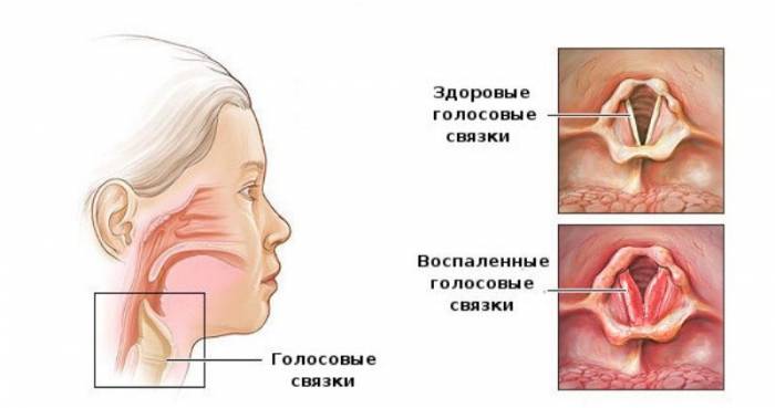 Воспаление голосовых связок на схеме