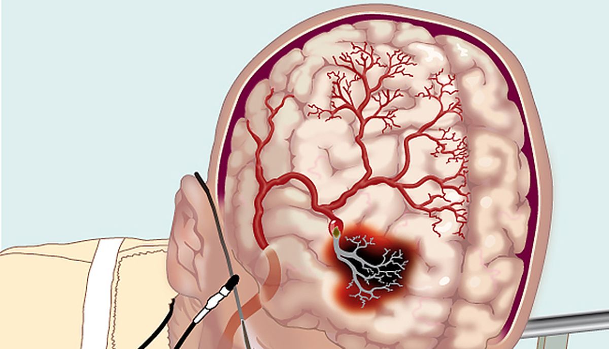 Картинки по запросу Нарушение мозгового кровообращения (инсульт)