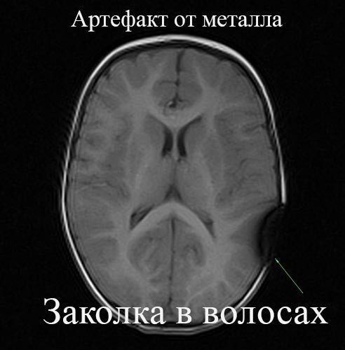 Можно ли делать МРТ с металлом в теле? магнитном, можно, список, делать, относится, случаи, металлов, такие, отклонения, притягиваются, металл, томографию, давно, ювелирка, посте, незначительно, ложиться, часто, магний, используют