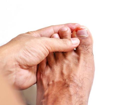 Повреждение ногтевой пластины при маникюре. Чем опасны травмы ногтей при маникюре и педикюре 02