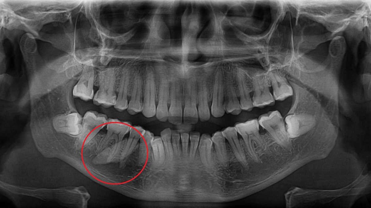Как «больной зуб» оказался огромным камнем в слюнной железе мужчины здоровье,стоматология