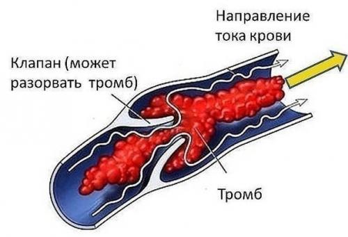 Тромбоз глубоких вен.