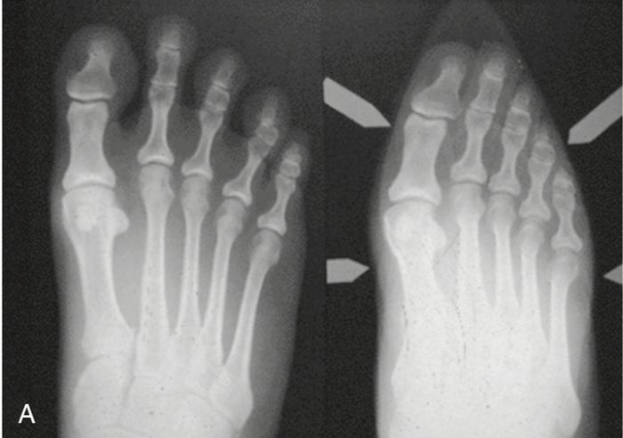 "Косточки" на стопах или hallux valgus hallux valgus,болезни,здоровье,медицина,стопы,хирургия