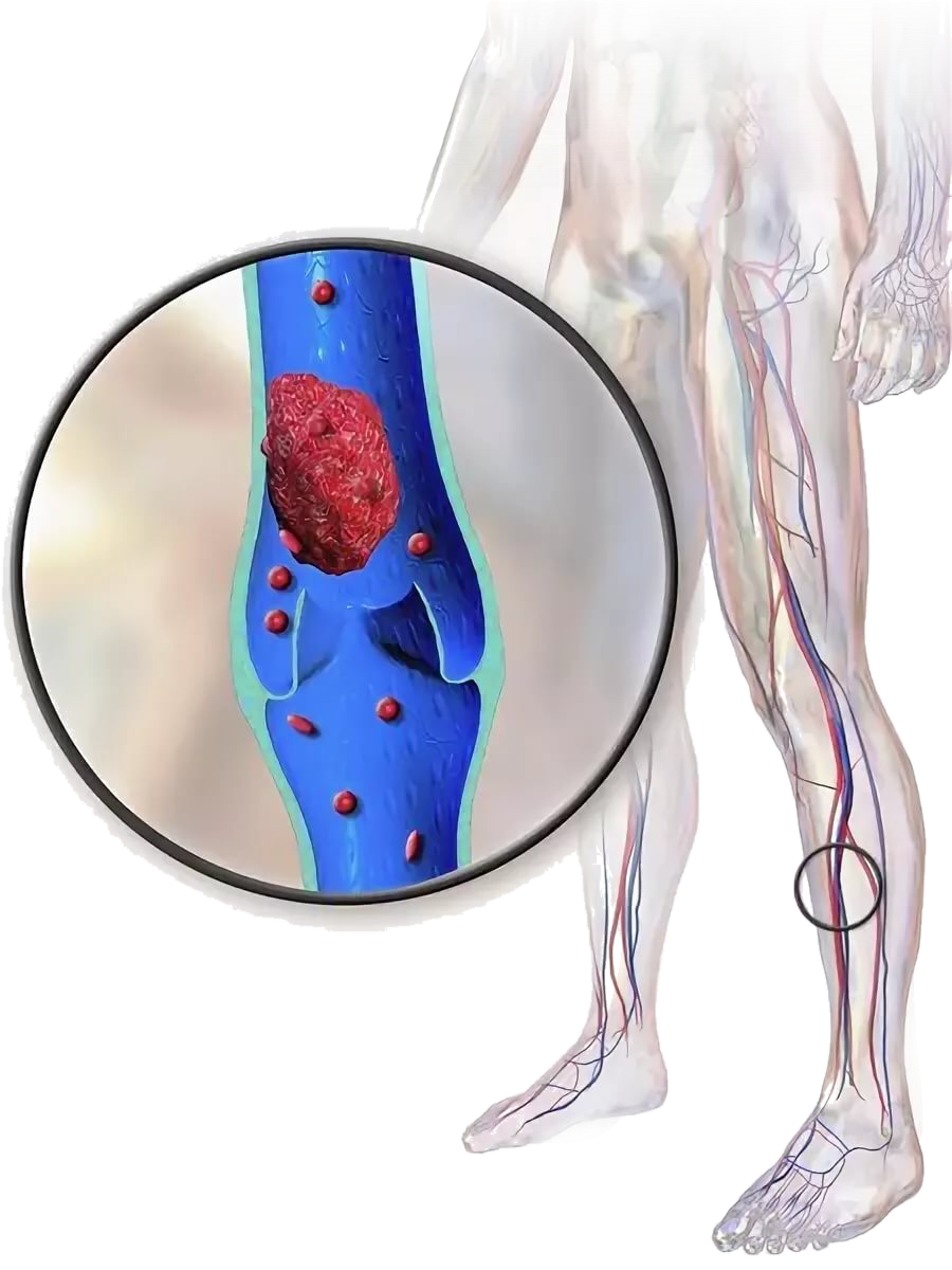 Острый венозный тромбоз клиника. Септический тромбофлебит. Тромбофлебит периферических вен. Илеофеморальный флеботромбоз. Причины тромбов симптомы