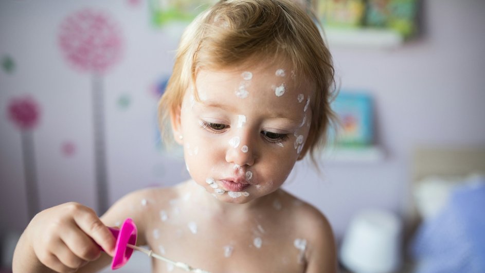 Ветрянка Ветрянка