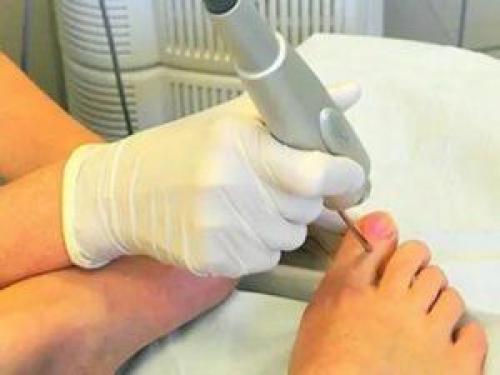 Повреждение ногтевой пластины при маникюре. Чем опасны травмы ногтей при маникюре и педикюре 01