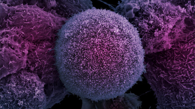 Раковая клетка в простате человека. Одиночные опухолевые клетки появляются в каждом из нас ежедневно, но подавляющее большинство дней иммунитет полностью убивает их. У 80% людей он удачно справляется с этим всю жизнь / ©LRI EM Unit