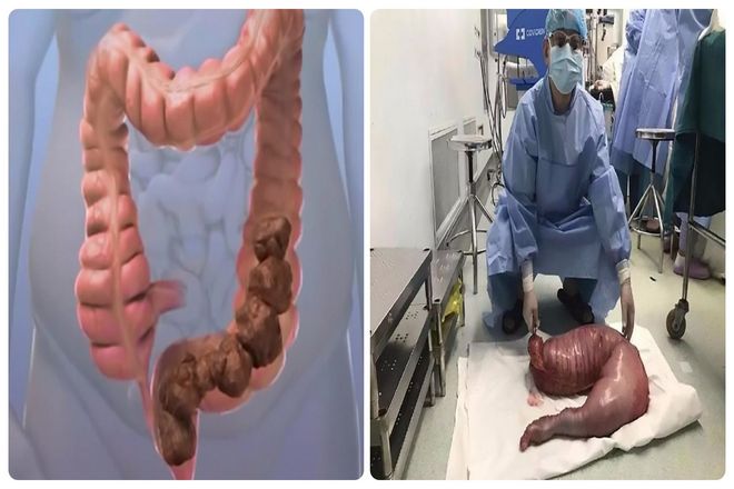 Однако такое бывает в редких случаях, как, например у 22-летнего китайца, всю жизнь страдавшего запорами. В 2017 году врачи хирургическим путем удалили почти 13 килограммов каловых масс из его воспаленной, вызывающей беспокойство толстой кишки.
