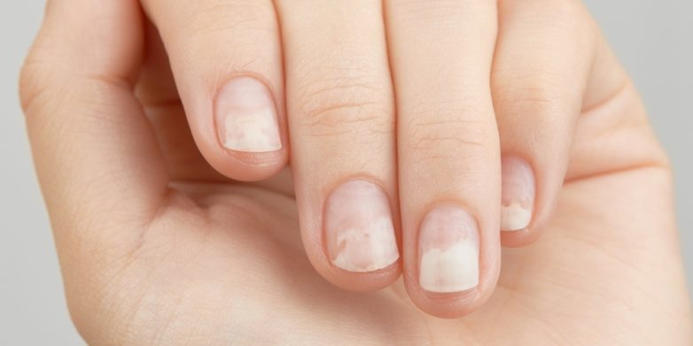 «У меня отслаивается и темнеет ноготь». Почему так происходит и что делать?