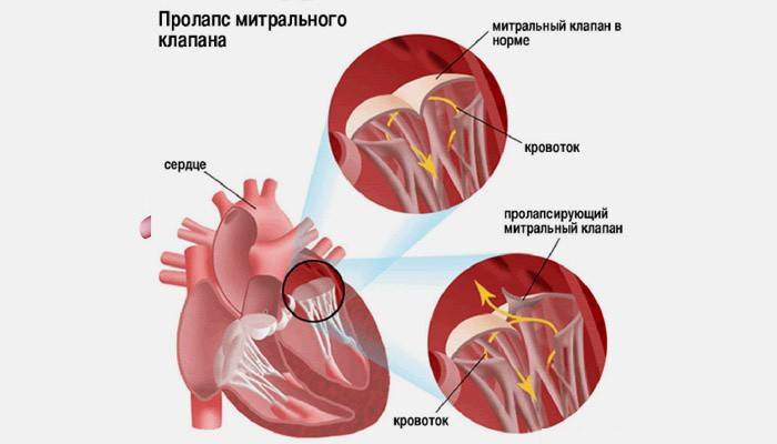 Пролапс митрального клапана 1 степени кардиология,медицина