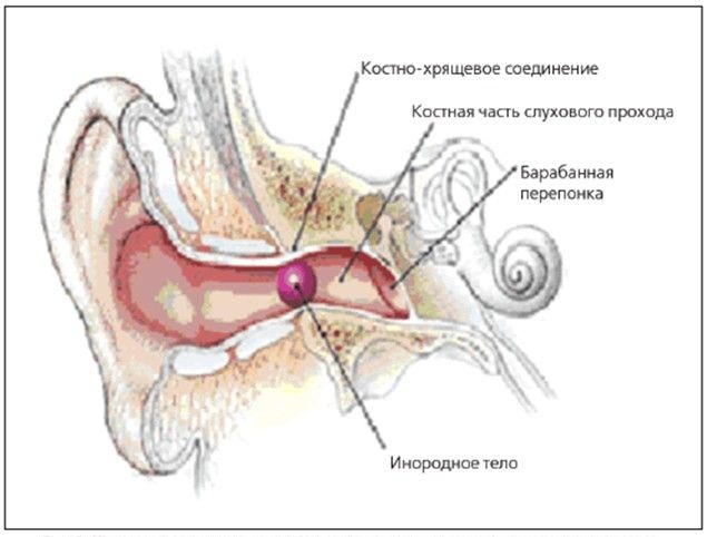 Инородные тела. Первая помощь здоровье,инородное тело,первая помощь