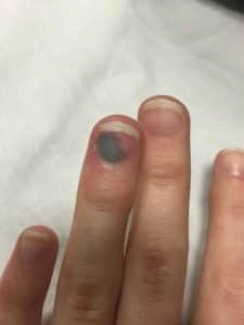 Повреждение ногтевой пластины при маникюре. Чем опасны травмы ногтей при маникюре и педикюре 03