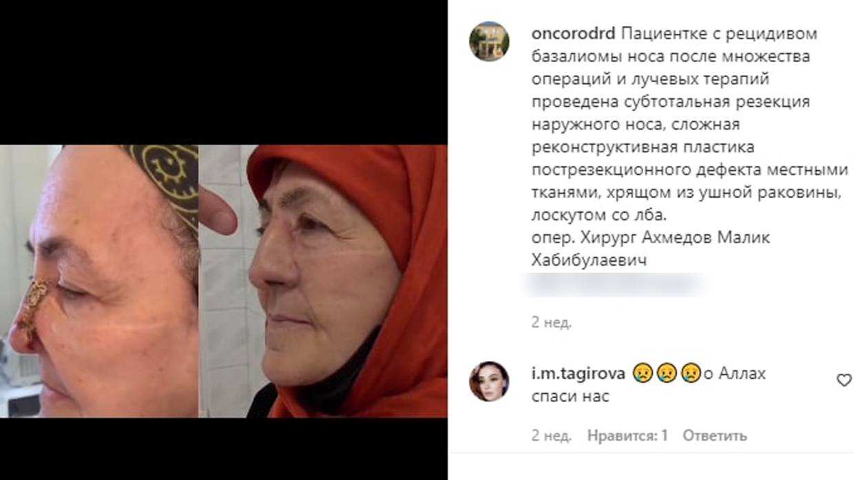 Врачи в Дагестане восстановили женщине нос, разрушенный раковой опухолью