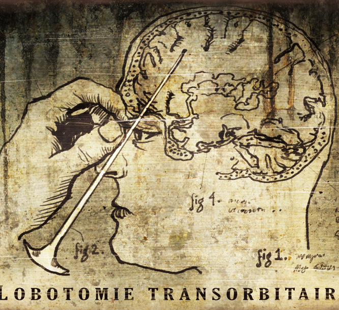 Операция, которой люди боялись веками: 10 фактов о лоботомии здоровье,история,медицина,наука,открытия