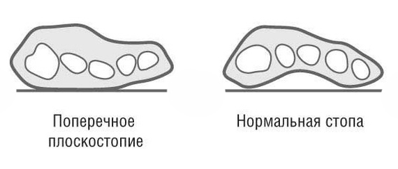 "Косточки" на стопах или hallux valgus hallux valgus,болезни,здоровье,медицина,стопы,хирургия