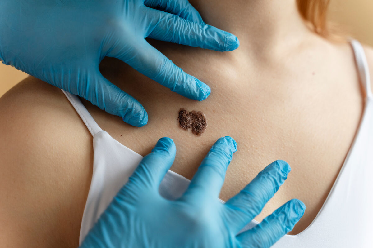 The Guardian: индивидуальный препарат от рака кожи снижает риск рецидива на 49%