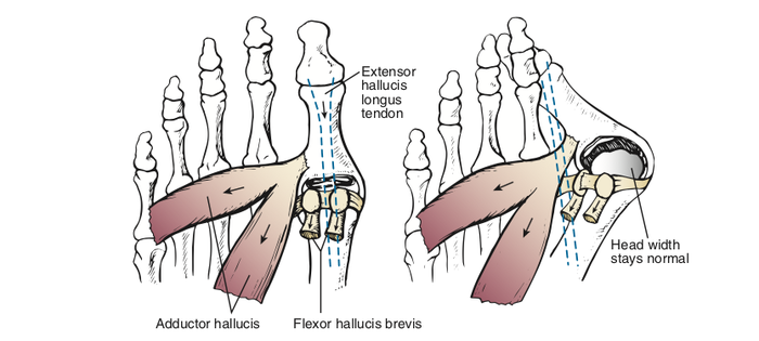 "Косточки" на стопах или hallux valgus hallux valgus,болезни,здоровье,медицина,стопы,хирургия