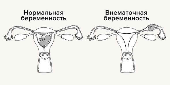 9 вопросов о внематочной беременности: что это, почему случается и можно ли потом иметь детей