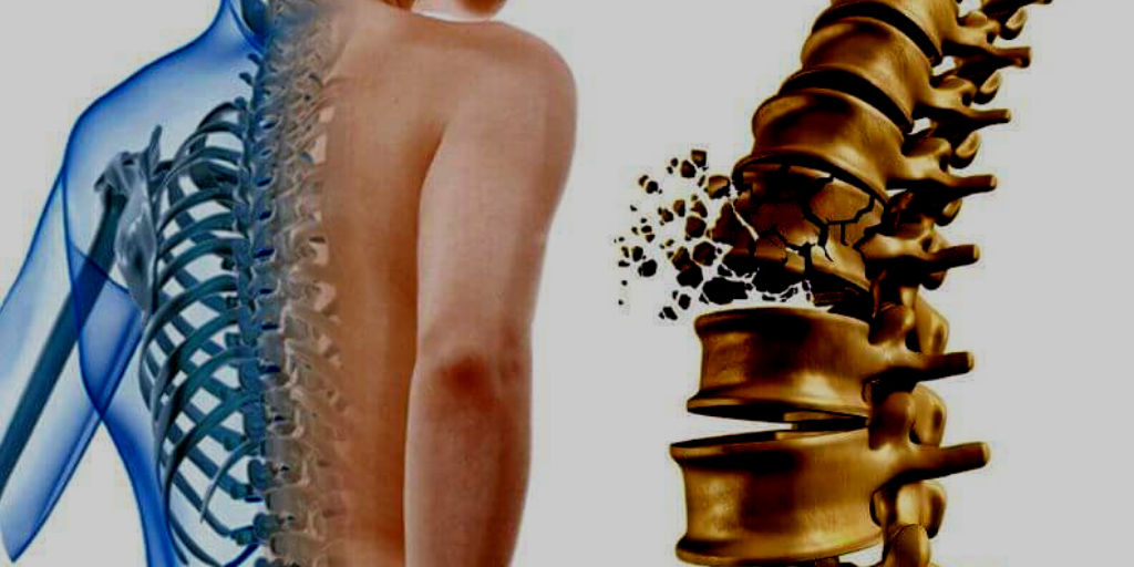 Опасность остеопороза. Что делать болезни,диагностика,здоровье,остеопороз,полезные советы
