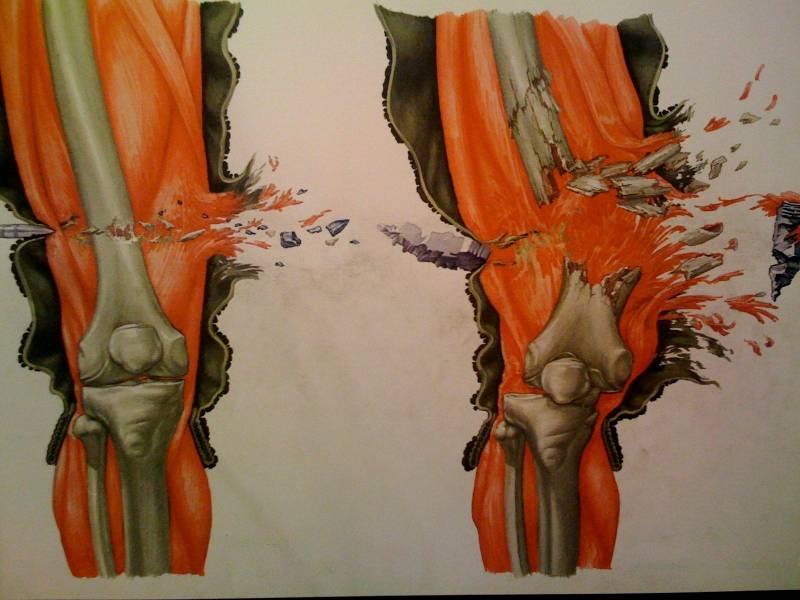 Новости не нашей науки: гидрогель от переломов