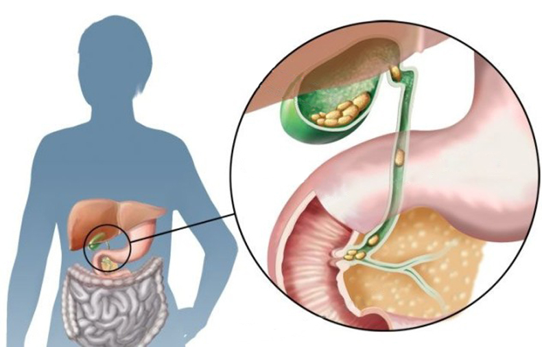 Чем опасна густая желчь и как распознать ее у себя желчный пузырь,желчь