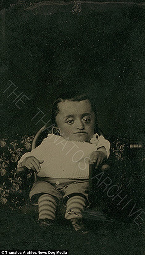 Ребенок с карликовостью, 1870-е годы деформация, люди