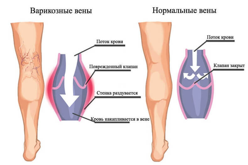 Варикозное расширение вен: упражнения Микулина кипятка, крови, минут, течение, настоять, расширение, листьев, ногах, ванны, нужно, упражнения, венах, время, сосудов, чтобы, появляются, расширении, процедить, стакана, расширения