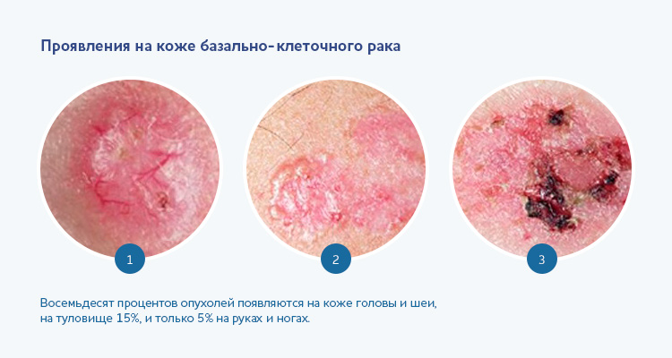 Проявления на коже базально-клеточного рака