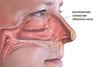 Как за пару минут избавиться от насморка без лекарств Как за пару минут избавиться от насморка без лекарств