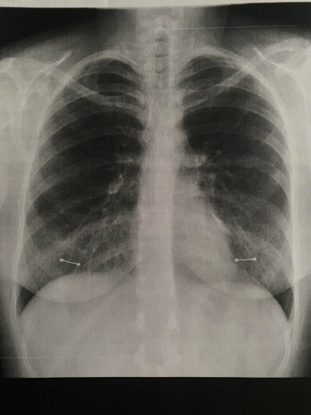 Рентгеновские снимки, глядя на которые так и хочется воскликнуть: "Слава Богу, не мои!" медицина,МРТ,рентген,рентгеновский снимок