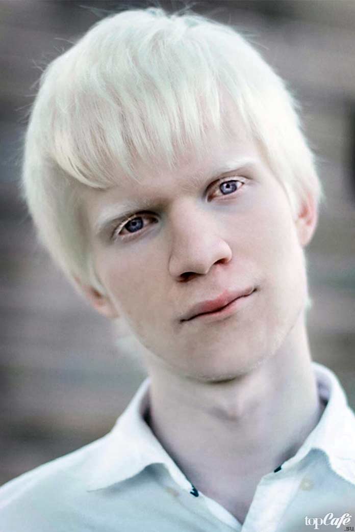 Люди альбиносы: Amal Sofi