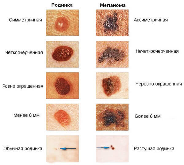 Проверьте родинку! В каких случаях нужно срочно к врачу родинки, могут, образование, меланомы, очертания, знать, может, признаков, невус, перерождение, которая, проверки, жизни, старайтесь, включая, более, солнца, разные, только, «АККОРД»