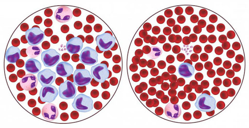 Почему понижены лимфоциты и что с этим делать анализ крови,болезни,здоровье