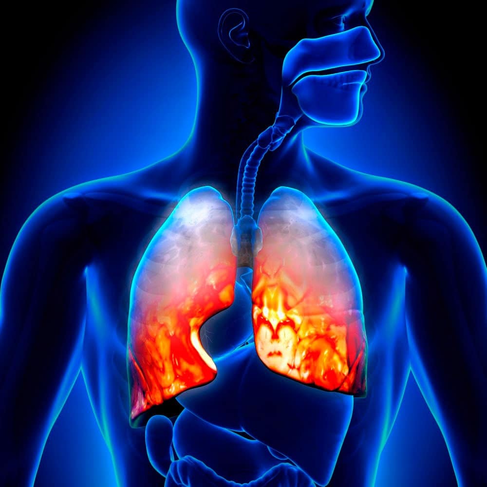 Застойная пневмония у лежачих больных болезни,здоровье и медицина