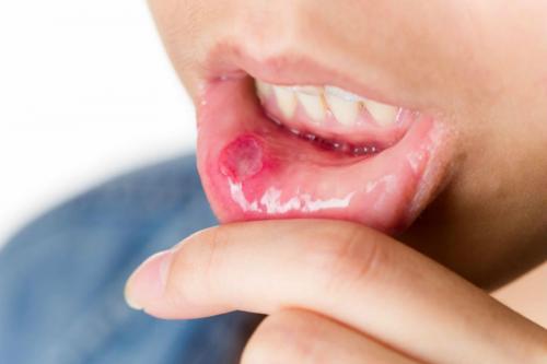 Болит язык лечение народными средствами. Грибковые, вирусные и бактериальные инфекции