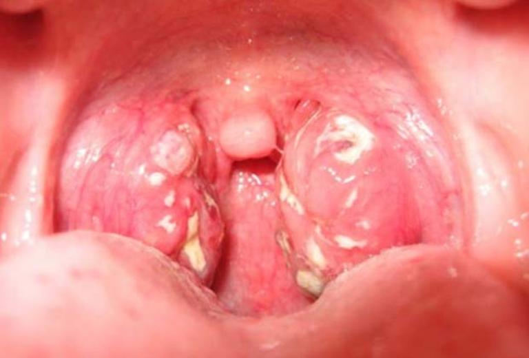 Иногда у пациентов в горле образуются беленькие комочки, которые дурно пахнут.