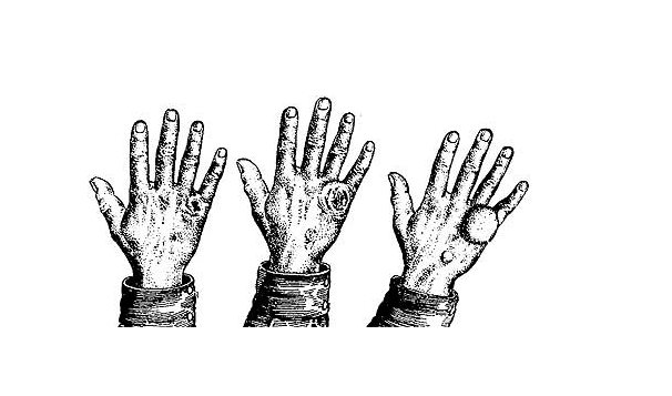 Ужасные раны или многолетнее отравление. Кожно-нарывные ОВ оружие