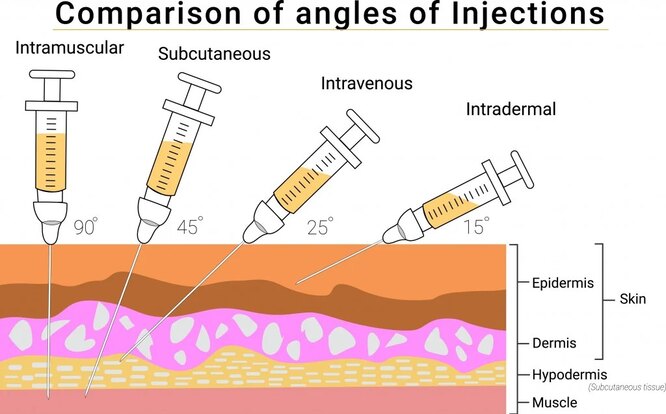 Почему уколы ставят в разные места инъекции,медицина,уколы