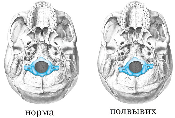 подвывих атланта