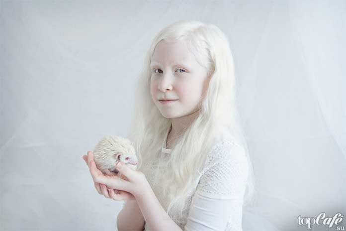 девочка альбинос
