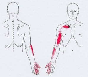 Карта точек боли в теле и точек напряжения мышц (триггеры)