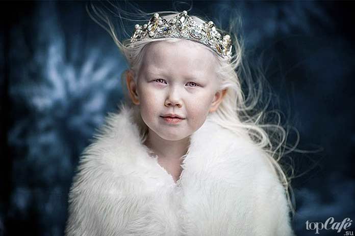 Люди альбиносы: девочка из Якутии