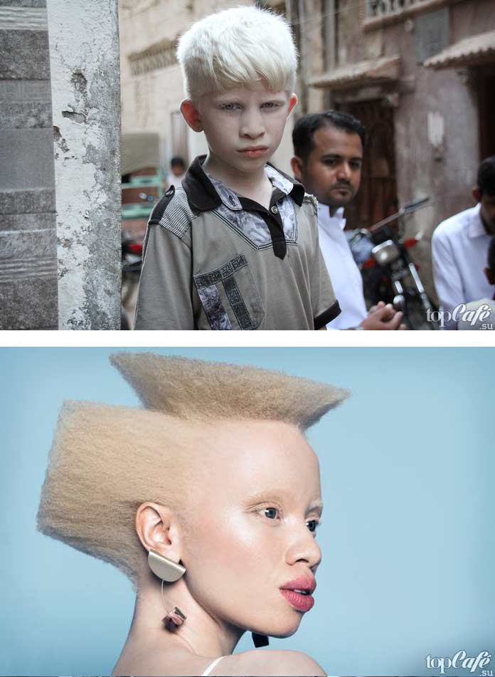 Фотографии людей альбиносов
